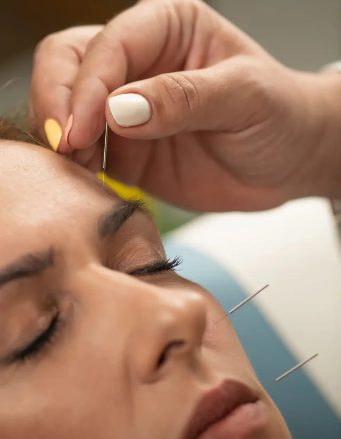 Acupuncture Treatment for Nervus Facialis